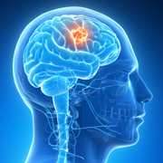 brain tumor scanner